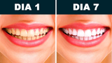 Clareador WhiteTeeth® - Exclusiva tecnologia